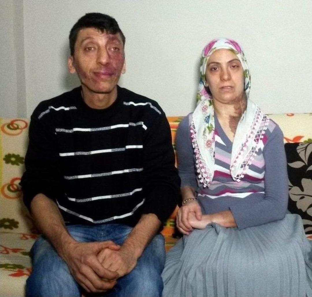 (&ouml;zel Haber) Y&uuml;zlerinde Doğuştan Yara Olan Kardeşlerin Dramı