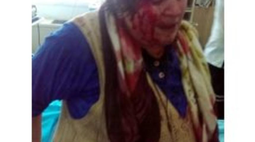 Kardeşi Tarafından Odunla D&ouml;v&uuml;len Kadın Hastanelik Oldu