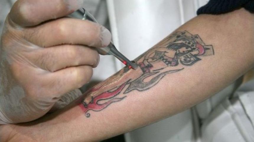 Dövme İzleri Tarihe Karışıyor