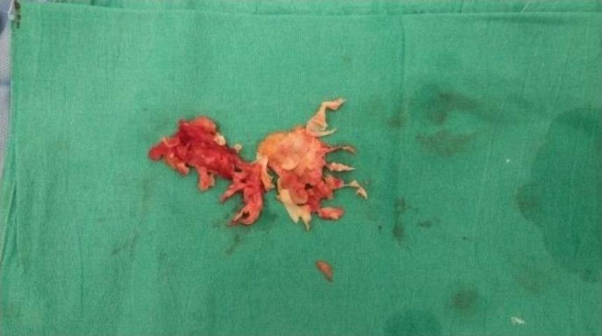 Damarları Temizlenerek Hipertansiyondan Kurtuldu