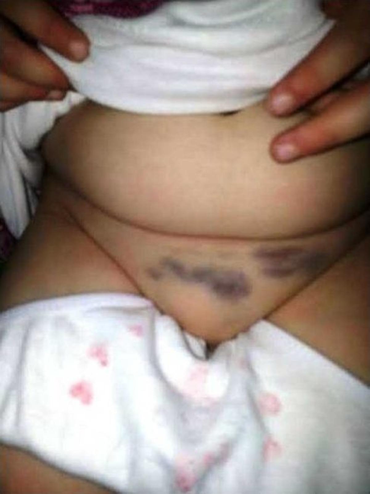 (&ouml;zel Haber) Kreşte Altına Ka&ccedil;ıran 3.5 Yaşındaki &Ccedil;ocuğa &Ouml;ğretmeninden Darp İddiası