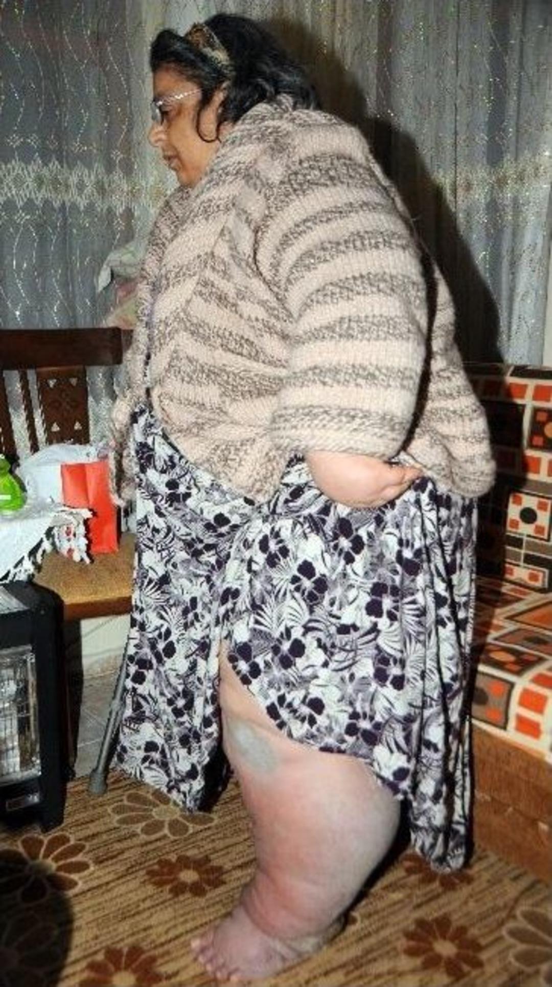 (&ouml;zel Haber) Yakalandığı Fil Hastalığı Eve Hapsetti