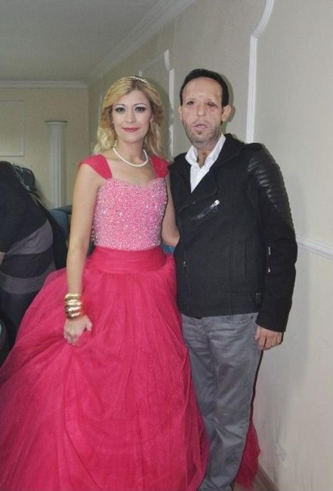 Y&uuml;z Nakli Yapılan Recep Sert D&uuml;nya Evine Girmeye Hazırlanıyor