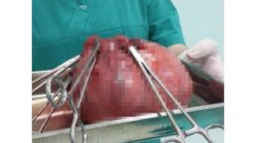 Rahminden Dört Kiloya Yakın Cisim Çıkarıldı