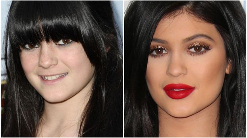 M&uuml;kemmel dudaklara kavuşmak hayal değil! &Ouml;ncesi ve sonrası dudak dolgusu