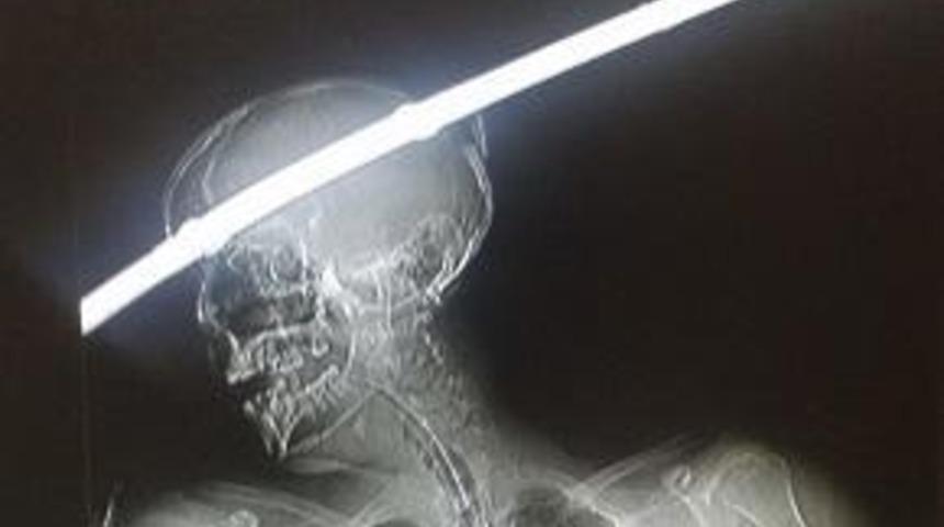 Kafasına bir metrelik demir çubuk saplandı! Hayatta kalmayı başardı!