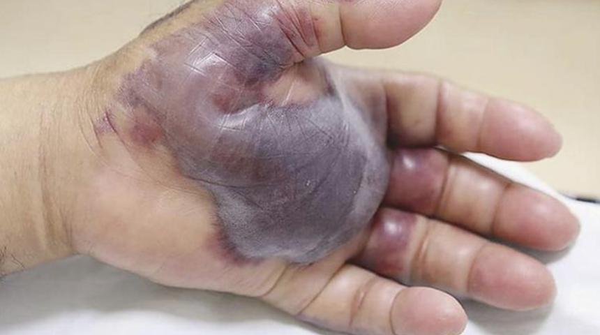 Ne yediğinize dikkat edin! 71 yaşındaki adam elini kaybetti