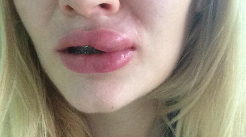 Dudak silikonu operasyonu hayatını kararttı!