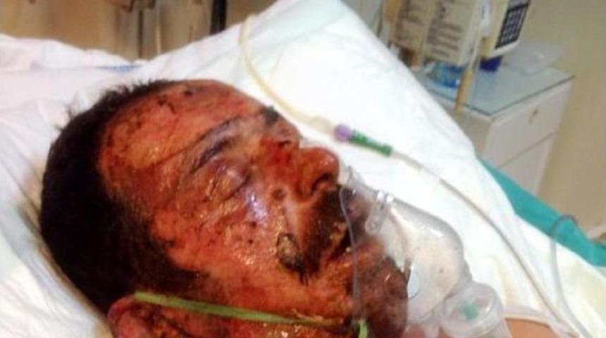 Oğlu Sopayla Vurdu, Eşi Benzin D&ouml;k&uuml;p Yaktı