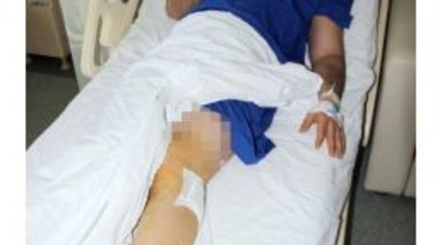 15 Yıldır Bacağında Cam Parçası İle Yaşadı