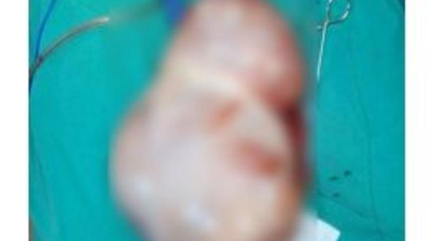 Gen&ccedil; Kızın Karnından Top B&uuml;y&uuml;kl&uuml;ğ&uuml;nde Kist &Ccedil;ıktı