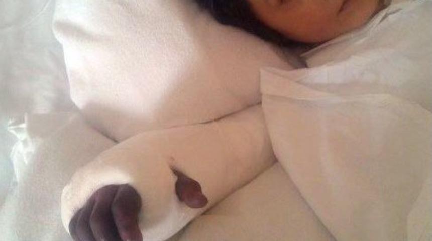 Karın Ağrısıyla Hastaneye Gelen Meryem&rsquo;in Kolu Kangren Oldu