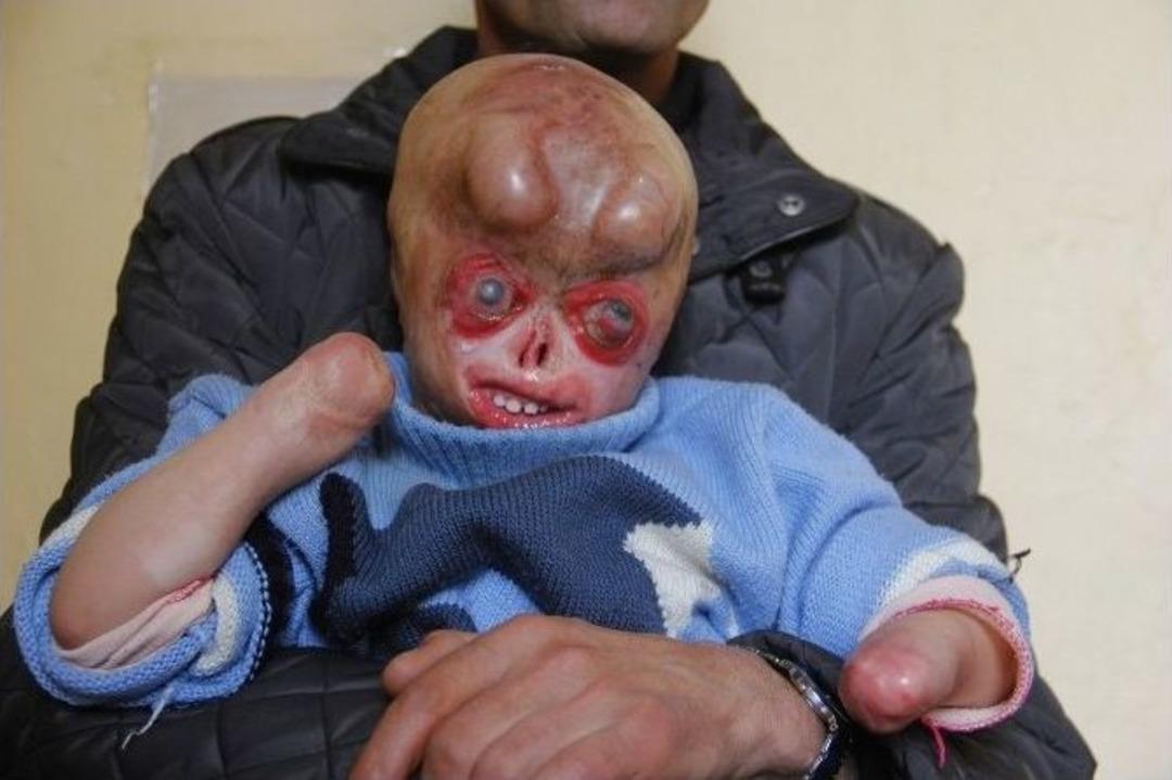 (&ouml;zel Haber) Minik Serkan&rsquo;ın İ&ccedil;ler Acısı Hali