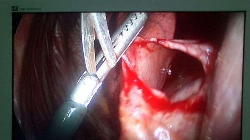 Uşak Devlet Hastanesinde Bir İlk Daha Yaşandı