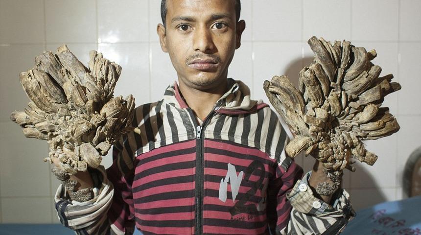 16 yıl sonra el ve ayağındaki k&ouml;kleri ameliyat ettirecek 