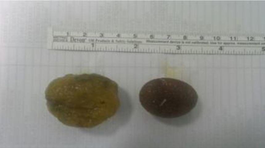 İnce Bağırsağından Taşlaşmış Yiyecek Kalıntısı &Ccedil;ıktı