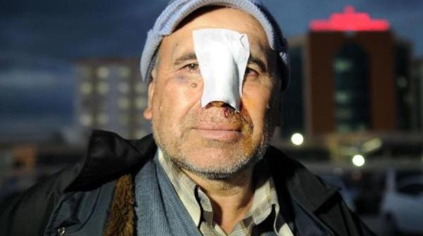 5 Hastane Dolaştı Ama Burnundaki Yaraya Dikiş Attıramadı