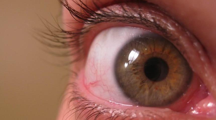 Bu hastalık &ouml;nemsenmediğinde k&ouml;rl&uuml;ğe kadar g&ouml;t&uuml;rebiliyor