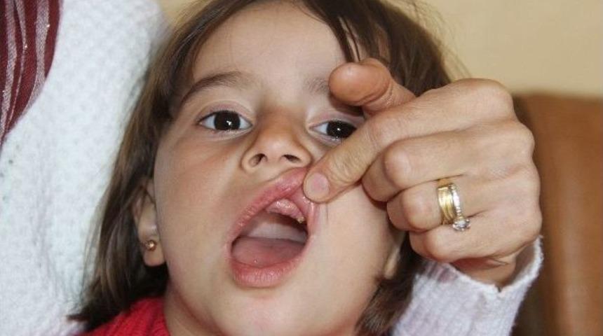 (&ouml;zel Haber) Dişleri Eriyen Nazlıcan Yardım Bekliyor