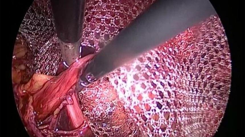 Doktor Şenol: &ldquo;kasık Fıtığının Tek Tedavisi Ameliyattır&rdquo;