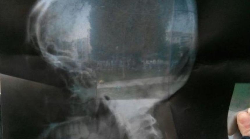 (&ouml;zel Haber) Kafasında Unutulan İğneler Sınırları Aştırdı