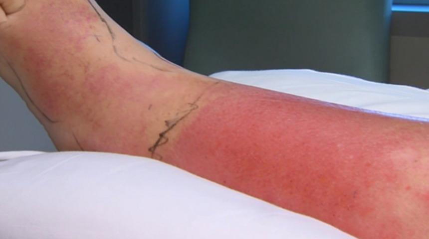 Pedik&uuml;rden enfeksiyon kaptı! Neredeyse &ouml;l&uuml;yordu