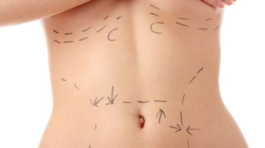 Hangi liposuction tekniği size daha uygun? Lazer mi Vazer mi? 