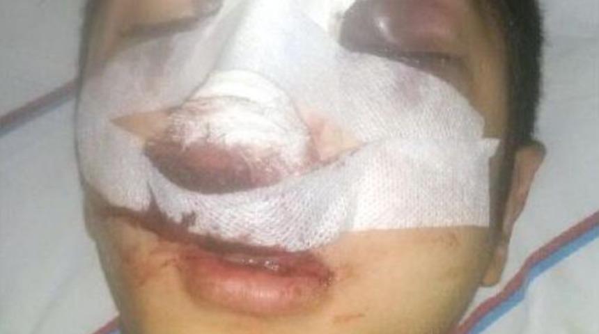 Burun Ameliyatı Yaptırdı, G&ouml;z&uuml;nden Oldu