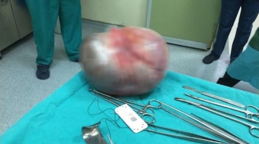 Karnından 4 Kiloluk Kitle &Ccedil;ıkartıldı