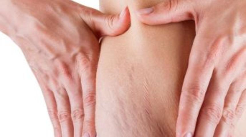 Doğum Sonrası &Ccedil;atlaklara &Ccedil;&ouml;z&uuml;m &Ouml;nerileri