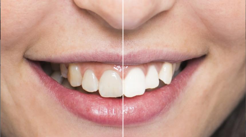 Dişleriniz ne renk?