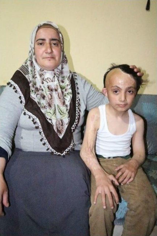 (özel Haber) Üç Yaşında Yüzü Yanan Mehdi’nin Dramı 2