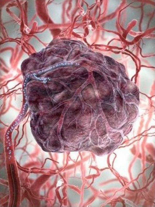 Karaciğer Kanserinin Yeni Düşmanı: Radyoembolizasyon