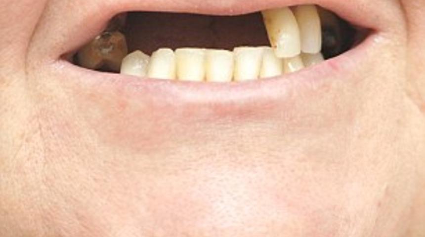 G&uuml;zelleşmek uğruna dişlerinden oldu