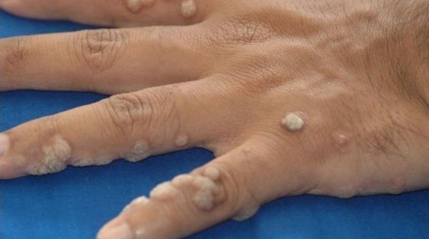 Utandıran Cilt Sorunu; Siğil