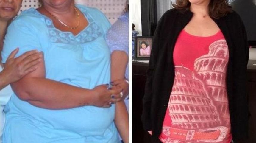 Ameliyatla 3 Hastalıktan Kurtuldu, 5 Ayda 32 Kilo Verdi