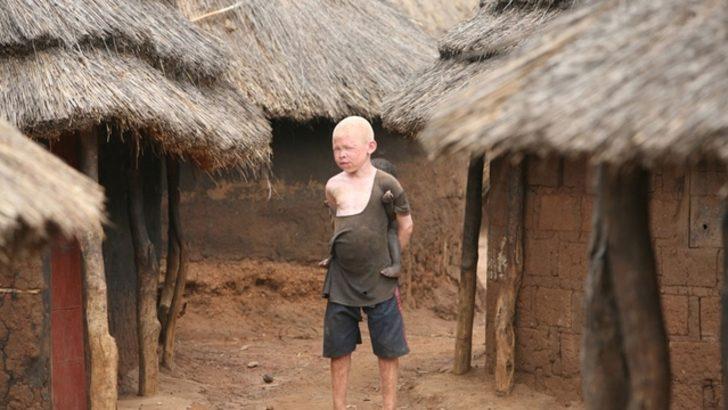 Tanzanya'da albino cinayeti