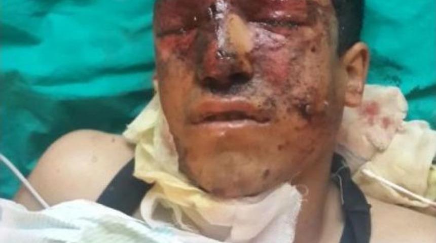 Madende Elinde Dinamit Patladı