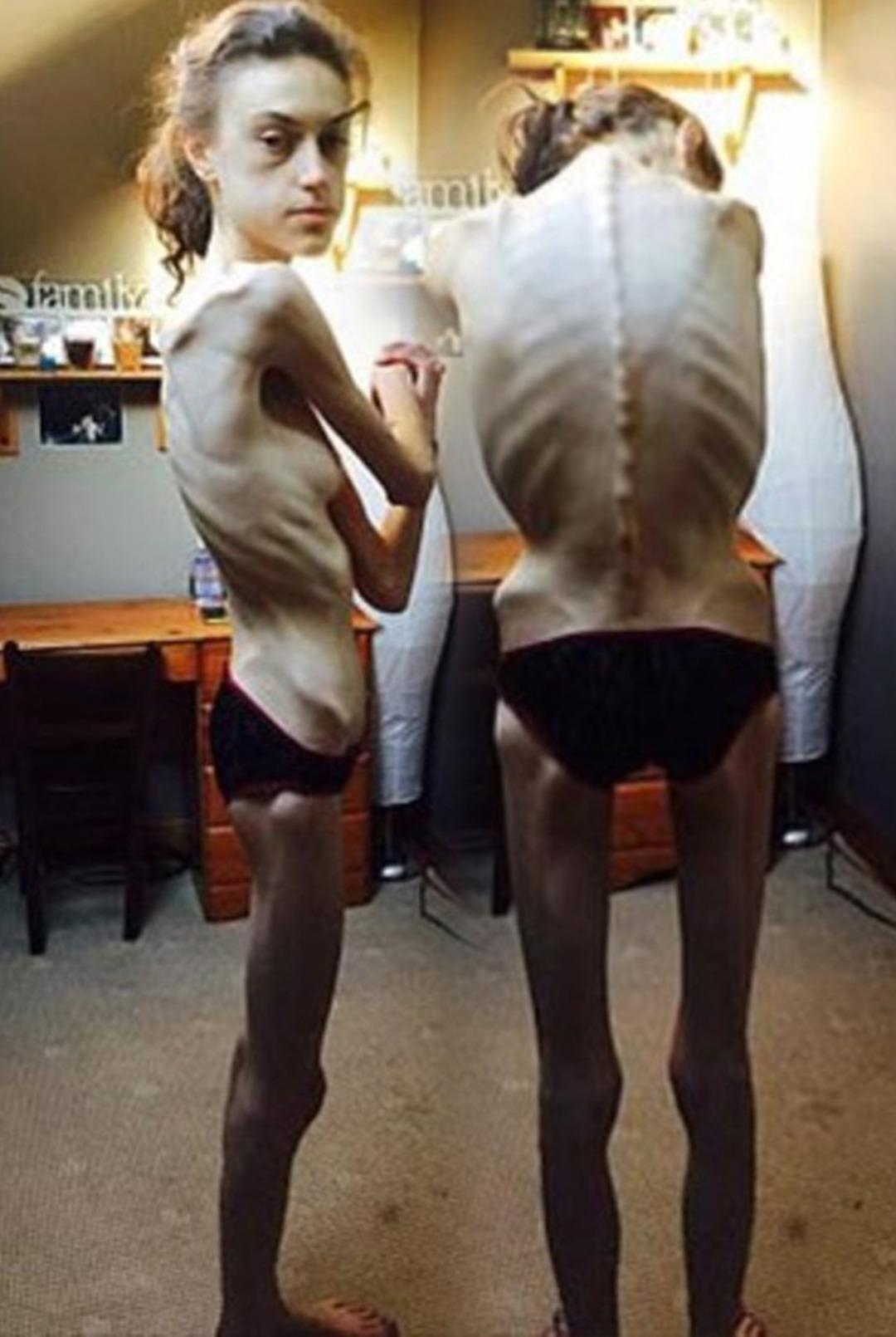 Yaptığı diyet y&uuml;z&uuml;nden &ouml;l&uuml;me burun buruna gelmişti! İşte son hali