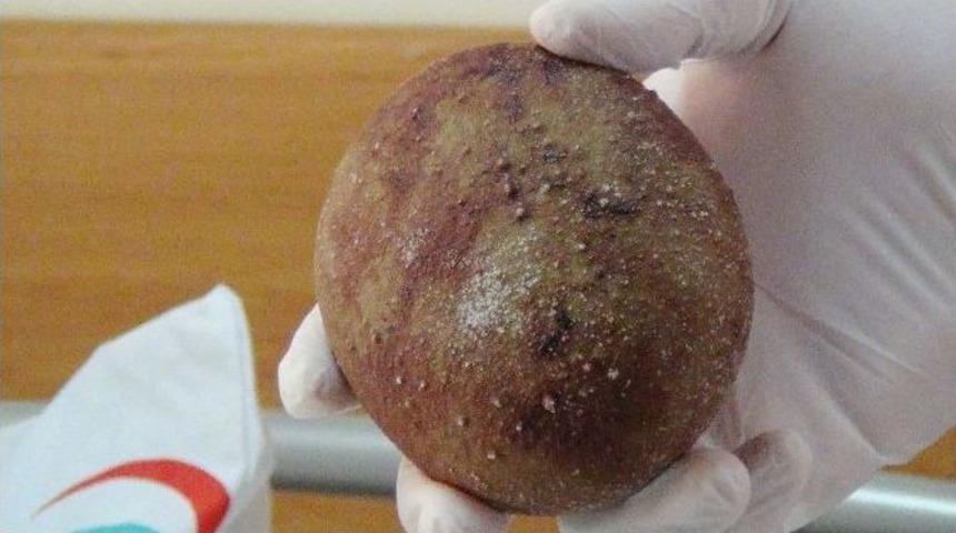 Mesanesinden 340 Gram Ağırlığında Taş &Ccedil;ıkarıldı