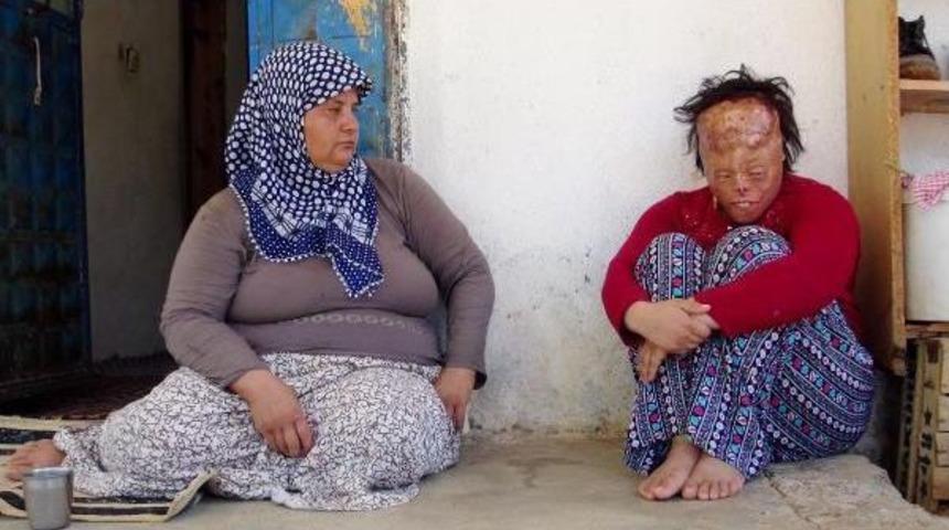 Y&uuml;z Nakli Bekleyen Leyla, &Ouml;nce Psikolojisinin D&uuml;zelmesini Istiyor