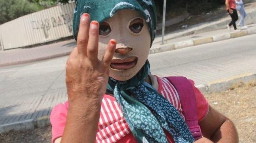 (&ouml;zel Haber) Savaş Mağduru Kız &Ccedil;ocuğu Maskeyle Yaşıyor