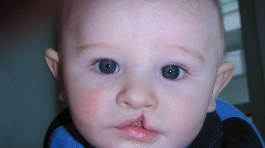 Bebeklerde Yarık Dudak Tedavisi