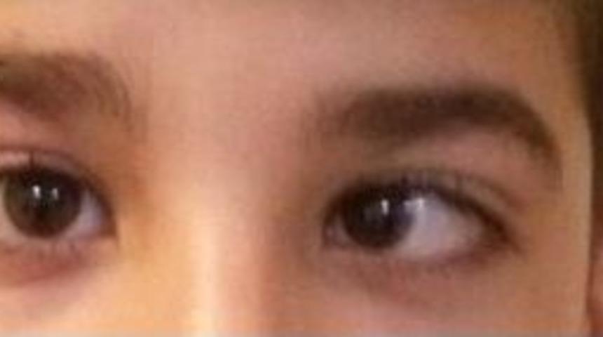 Op. Dr. Yakut: "şaşılık Her Yaşta G&ouml;r&uuml;lebilir"