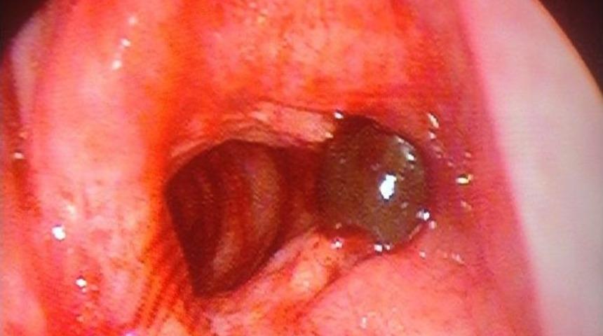 Ses Tellerine S&uuml;l&uuml;k Yapışan Şahıs Ameliyat Edildi