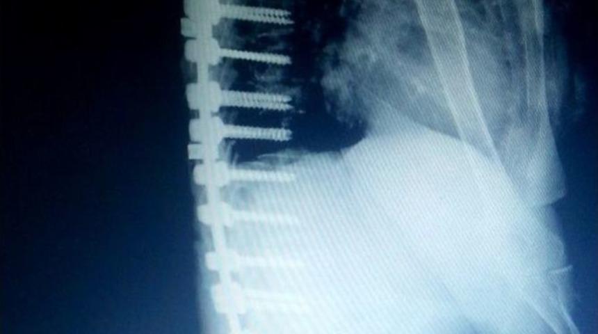 Edremit&rsquo;te Bir Hastaya Erimeyen Platinden Omurga Yapıldı