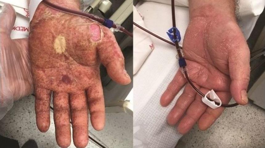 Romatizmal Hasta &lsquo;aferez Tekniği&rsquo; Sayesinde Sağlığına Kavuştu