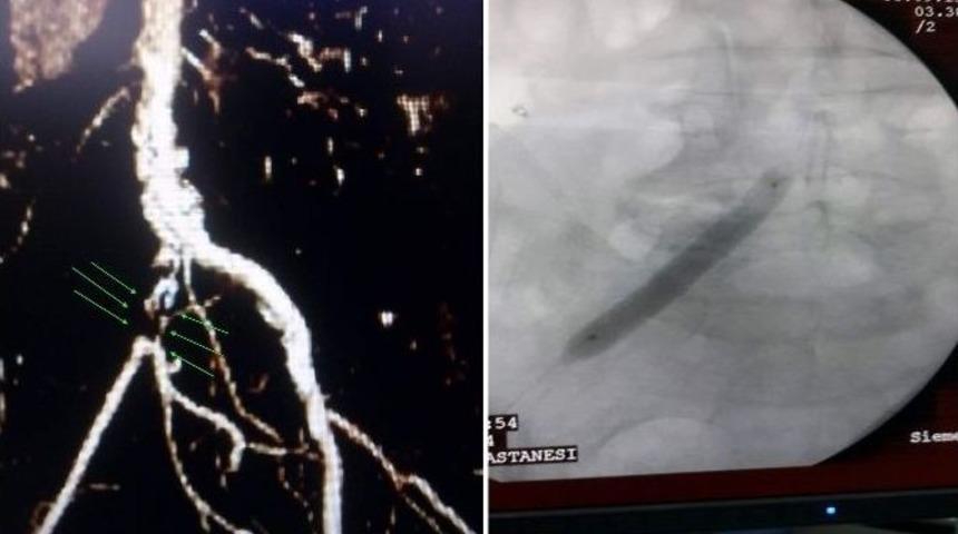 Nevşehir&rsquo;de İlk Defa Bacak Ana Atardamarına Balon Ve Stent Uygulaması Yapıldı