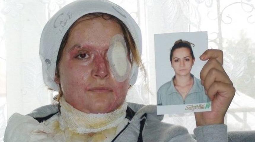 Kocasının Kezzapla Yaktığı Kadın Yardım Bekliyor