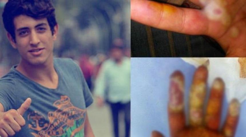 'Radyoaktif tespih' hayatını kararttı! İşte 18 yaşındaki gencin 1.5 yıl boyunca yaşadıkları